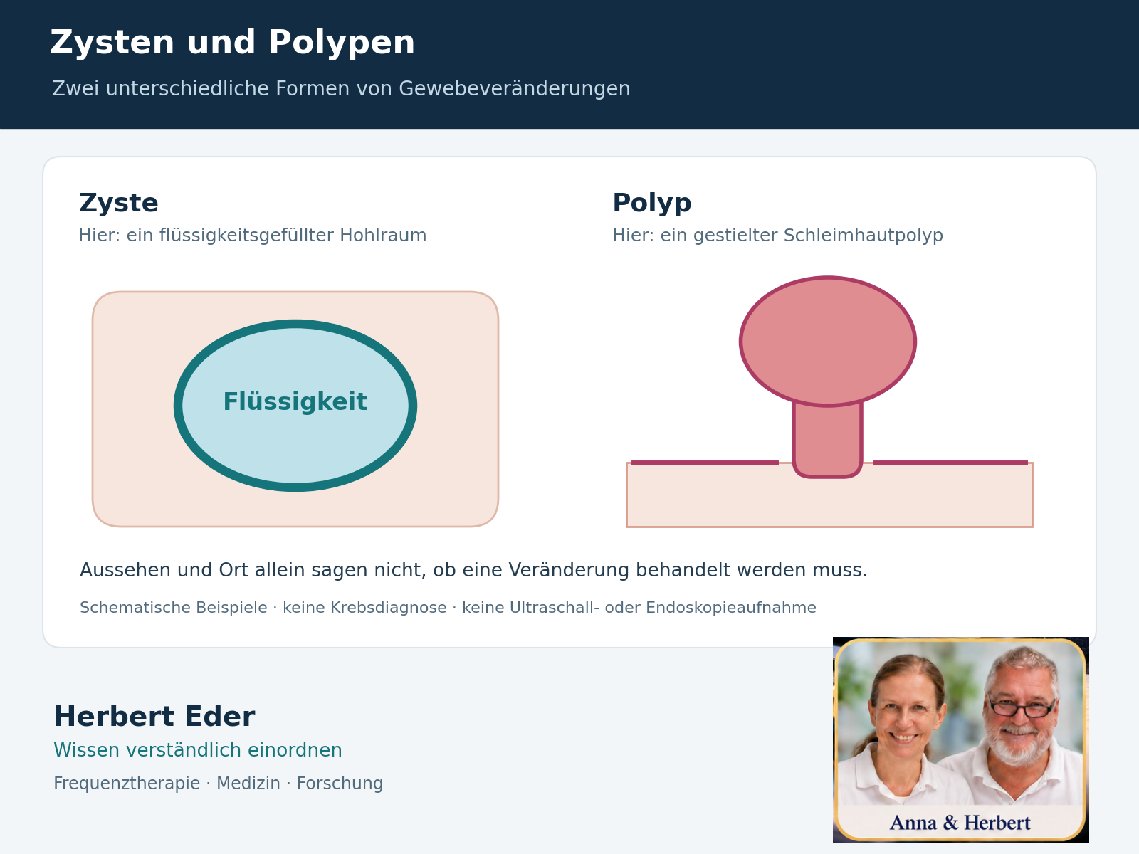 Schematische Gegenüberstellung einer flüssigkeitsgefüllten Zyste und eines gestielten Schleimhautpolypen.